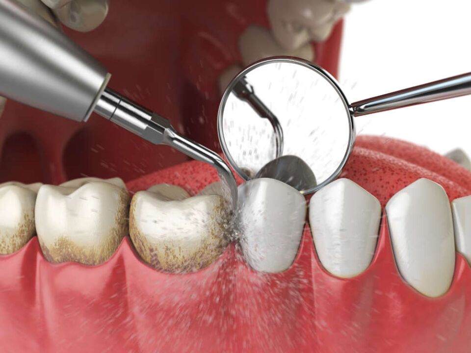 Does Deep Cleaning Stop Gum Disease Is Deep Cleaning Painful
