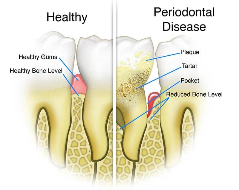 Healthy Teeth Vs Gum Disease What Is A Periodontal Cleaning