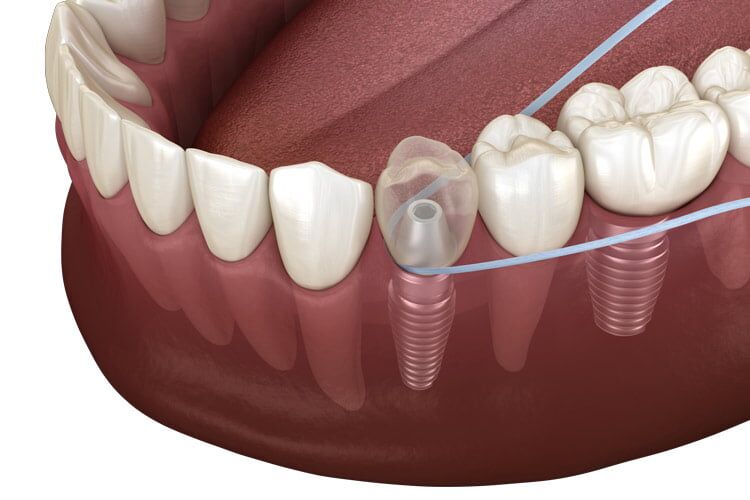 Implant Cleaning How To Clean Dental Implants